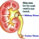 Removal of Kidney Stones گردے کی پتھری کاعلاج